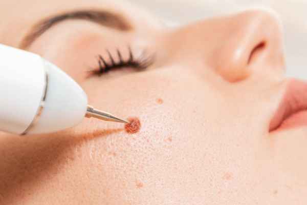 CryoPen: 5 Skin Concerns It May Be Used to Treat 3 What actually happens during a CryoPen treatment Chippenham?