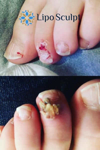 Wart removal customer results from Lipo Sculpt Chippenham