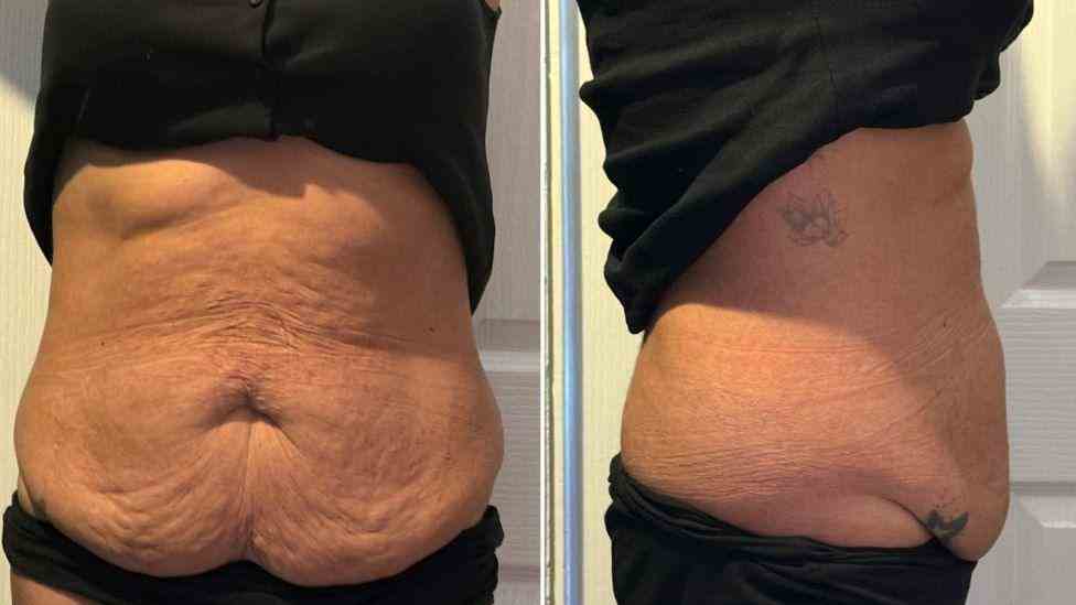 Lost the Weight but Not the Loose Skin? What You Should Know 1 Is It Definitely Loose Skin Chippenham?